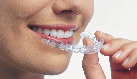 O que é Invisalign?